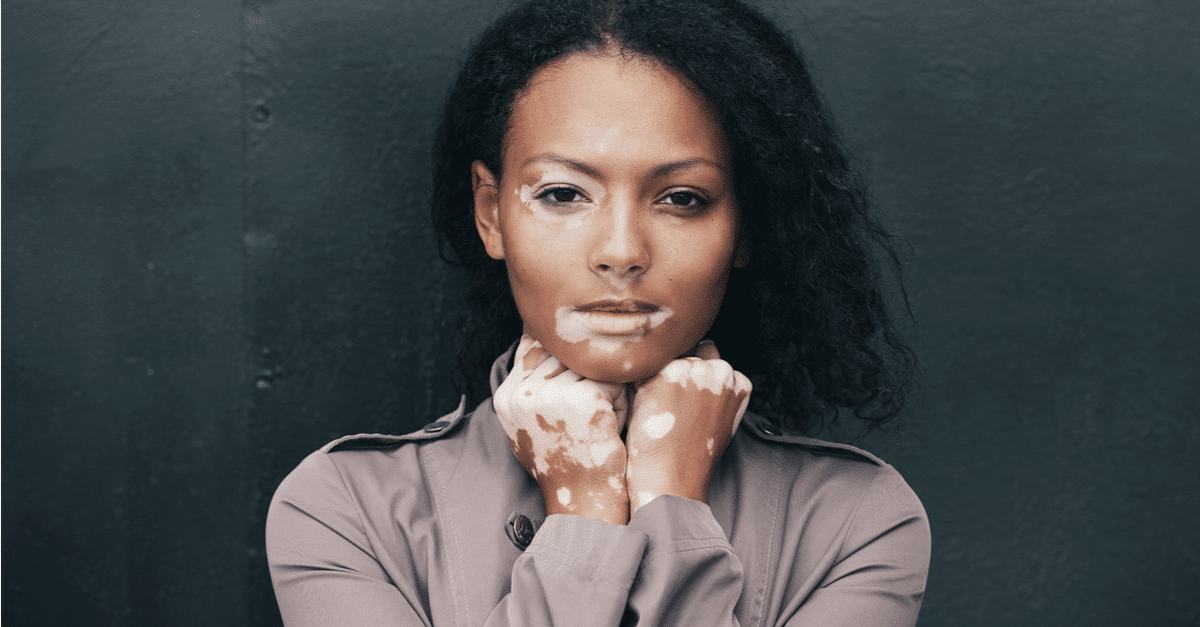 O que é vitiligo? | MilPeles Dermatologia e Estética